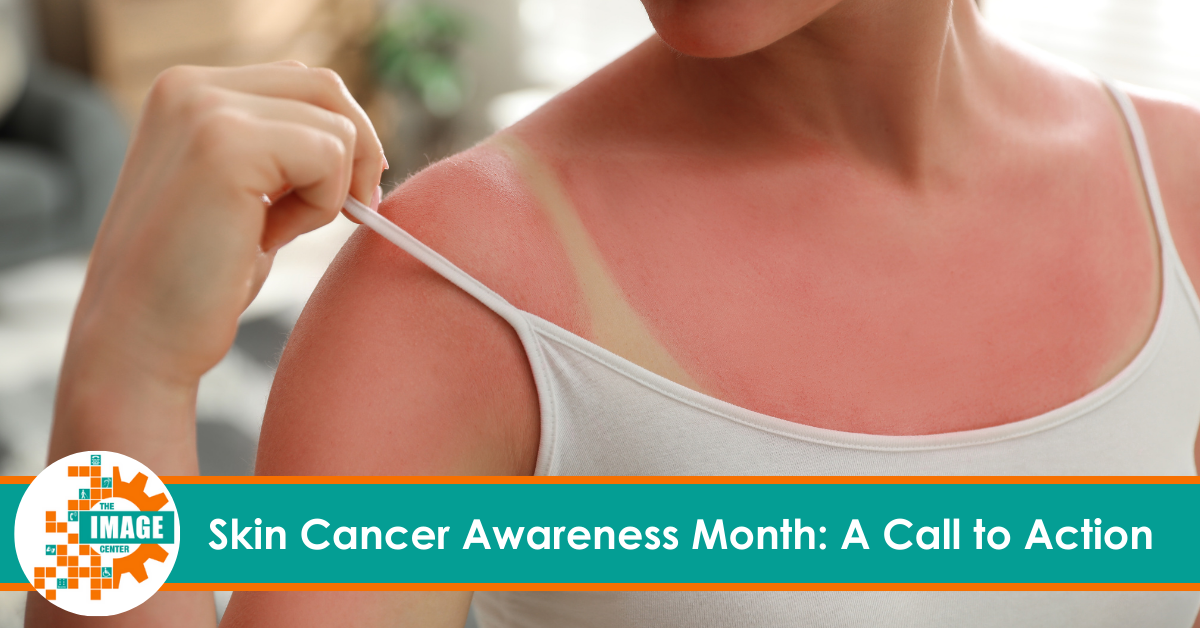 Woman pulling a tank top strap off her shoulder revealing severe sunburn.